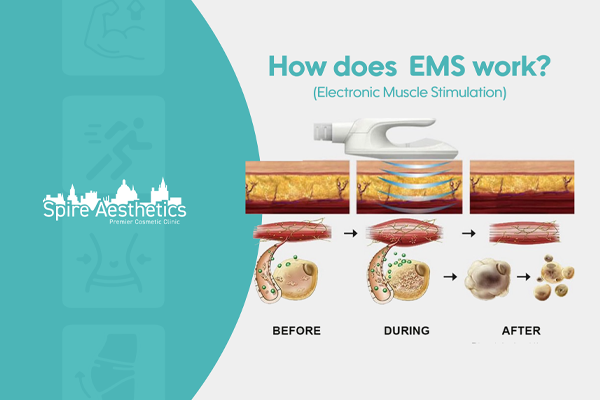 EMS treatment for post pregnancy weight loss treatment Hampton in Arden