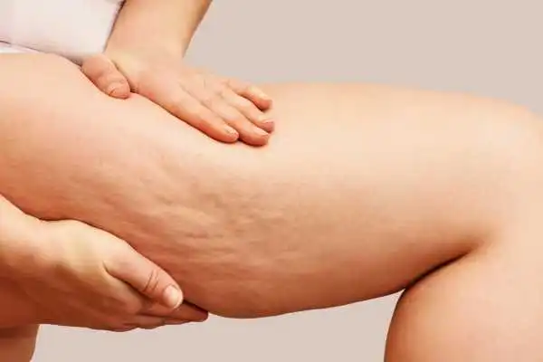 Image of woman showing leg with cellulite Hampton in Arden
