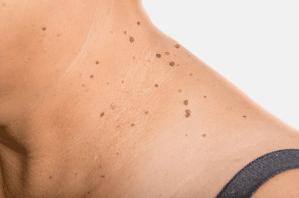 Are you looking for easy skin tag removal Hampton in Arden - then contact Spire today!