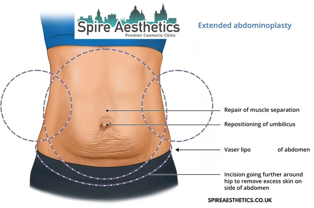 Understanding Loose Skin After Gastric Band Hampton in Arden Surgery and HIFU Treatment