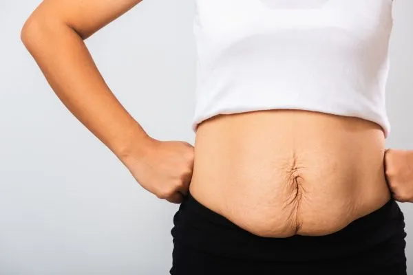 Image of a woman's stomach after weight loss with sagging skin following a gastric band Hampton in Arden