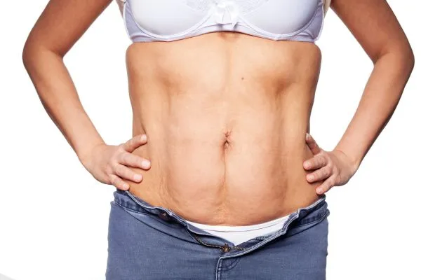 sagging skin on woman's stomach after weight loss injections Hampton in Arden