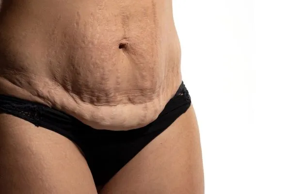 Image of womans stomach after weight loss injections Hampton in Arden showing saggy skin
