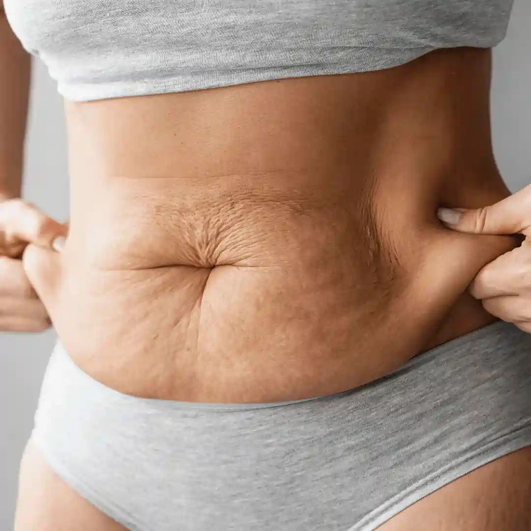 Is It Normal to Have Loose Skin After Pregnancy Hampton in Arden?